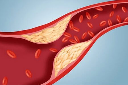 Атеросклероз